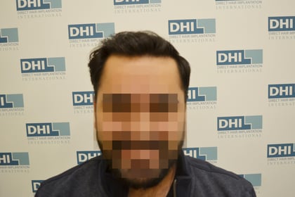 After Hair Transplant Procedure 