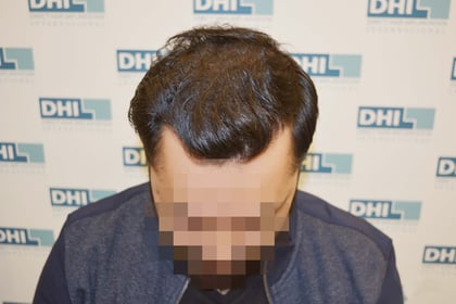 After 6 Month - Hair Transplant Surgery