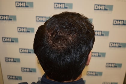 Rohan’s Hair Transplant Glorious Journey at DHI India 