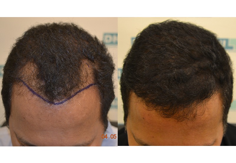 DHI CEO DHI Hair Transplant