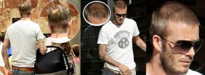 Beckham Hair Transplant Journey 