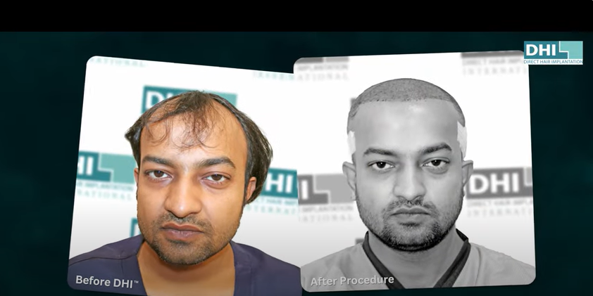 Before & After Hair Transplant