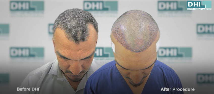 Mr. Roberts Before & After Hair Transplant Surgery