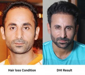 Before & After Results