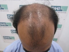  Before the Hair Transplant Procedure