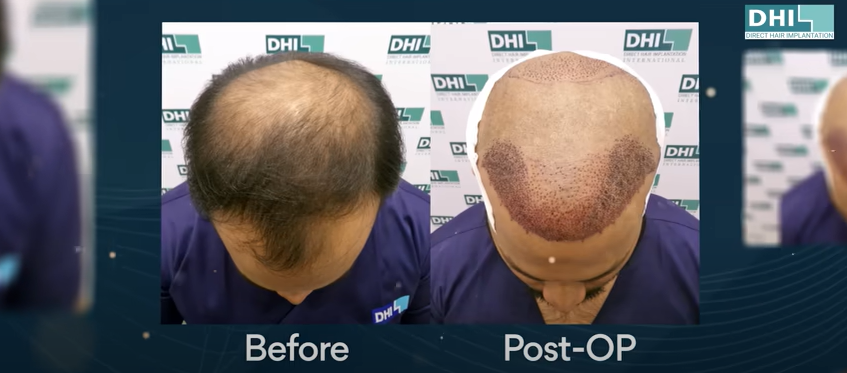 Before & Post Operation