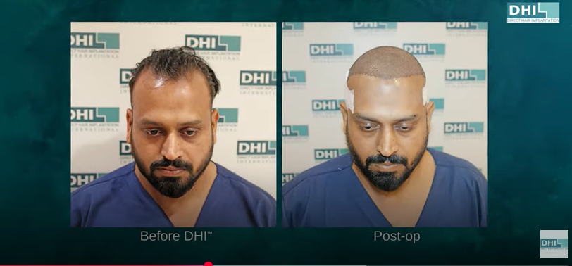 Gaurav Garg Hair Transplant Before and After OP