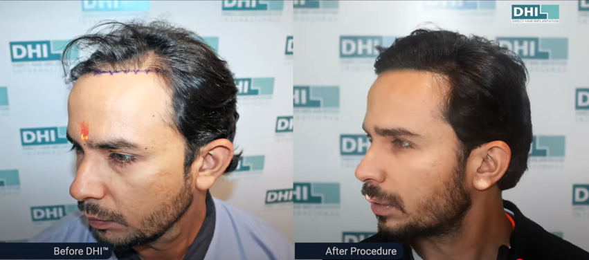 Sumit Choudhary’s hair transplant