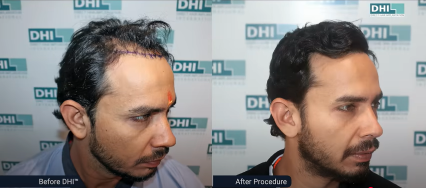 hair transplant results before and after