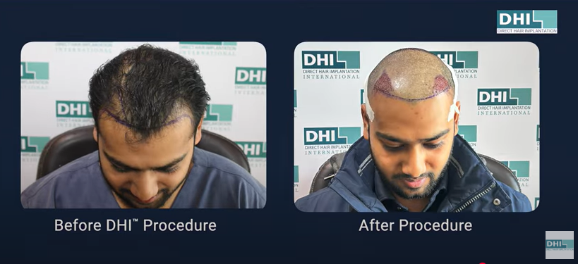 Before and after hair transplant procedure
