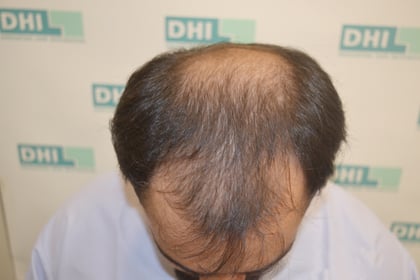 Before Hair Transplant Surgery at DHI India