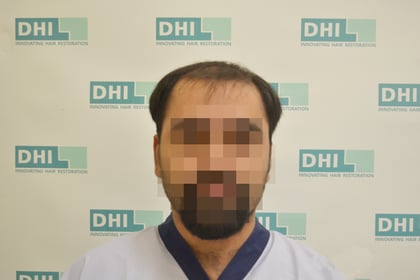 Before Hair Transplant Procedure at DHI India