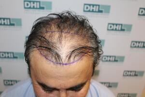 Before Hair Transplant Procedure