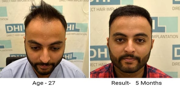 Hair Transplant Results After 5 Months