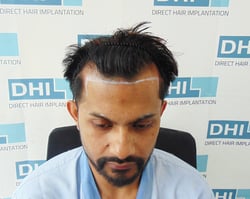 Sudipto Dass  Hair Transplant
