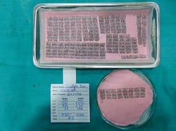 High Density Hair Transplantation