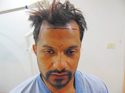 Sudipto Dass  Hair Transplant Procedure