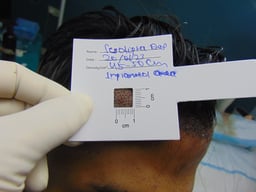 Hair Transplant Treatments Procedure