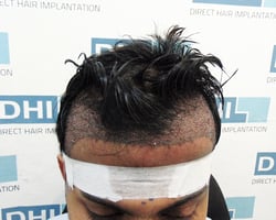 Sudipto Hair Transplant Procedure at DHI 