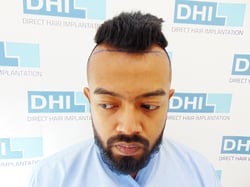 Swoujas’s Hair Transplant Journey in DHI