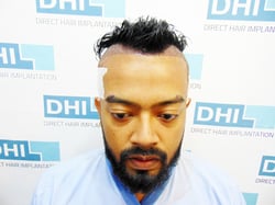 Swoujas’s Hair Transplant Process