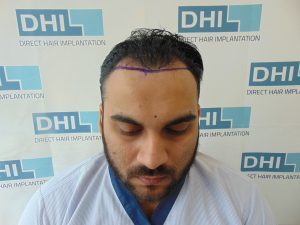 MD. Zaid Asraf Hair Transplant Surgery