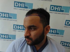 MD. Zaid Asraf Hair Transplant Surgery Procedure