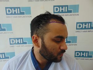 Before Hair Transplant Surgery