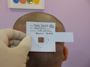 MD. Zaid Asraf Hair Graft Details