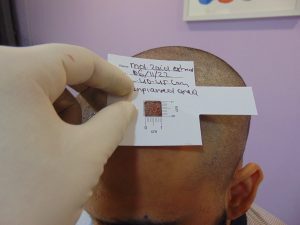 Hair Graft Procedure