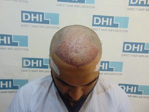 MD. Zaid Asraf After Hair Transplant Surgery