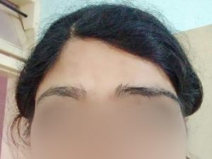 Eyebrow transplant for acid burnt victim dHI