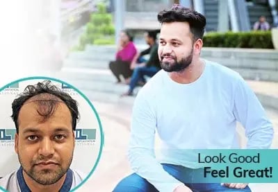 Prince Kumar Hair Transplant Journey at DHI Clinic