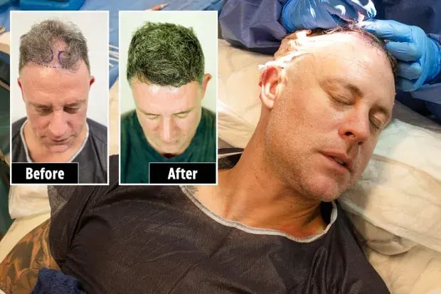 Wayne Bridge Hair Transplant Surgery