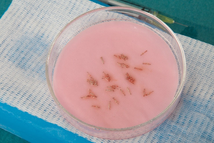 Hair Transplant Results