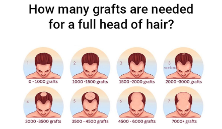 Hair Graft Count