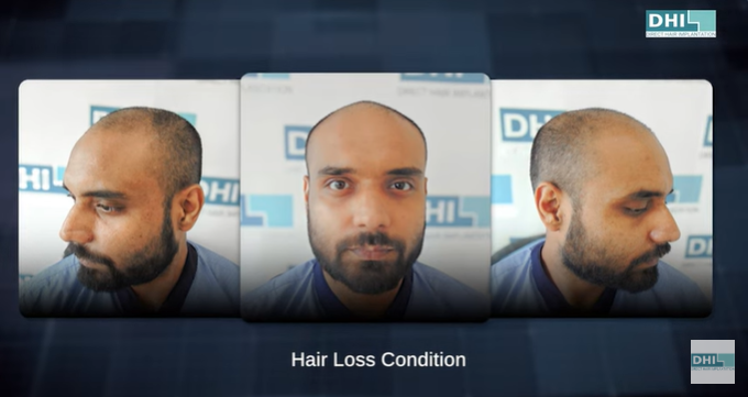 Hair Loss Condition