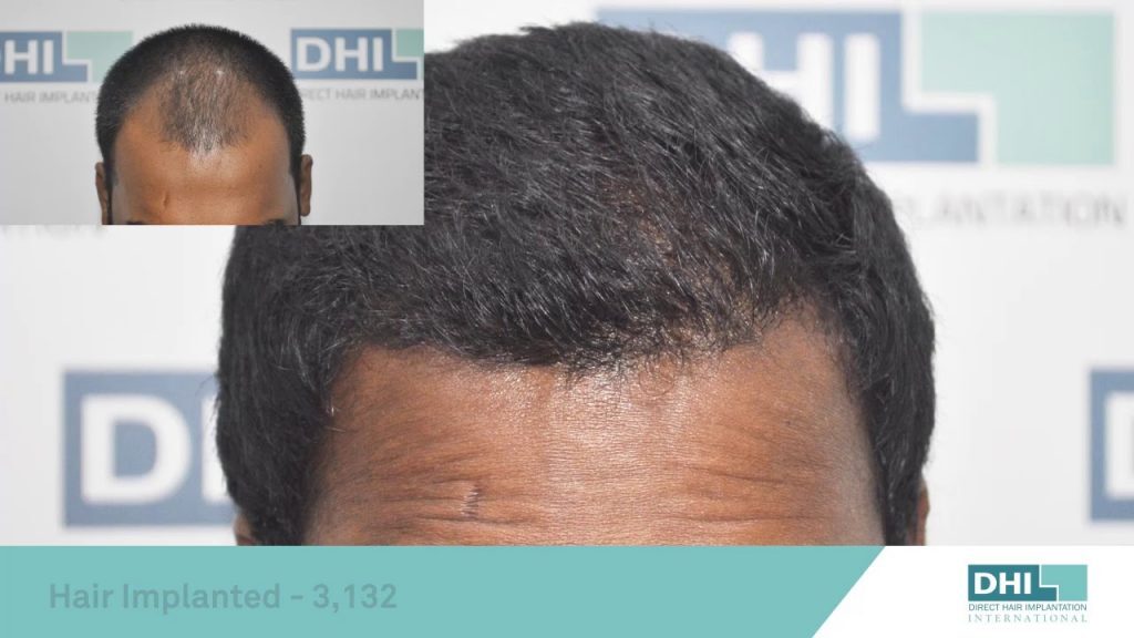 Hair transplant surgery