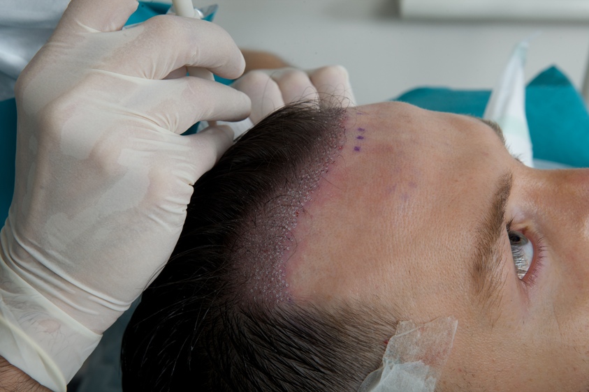 Hair Transplant Implantation