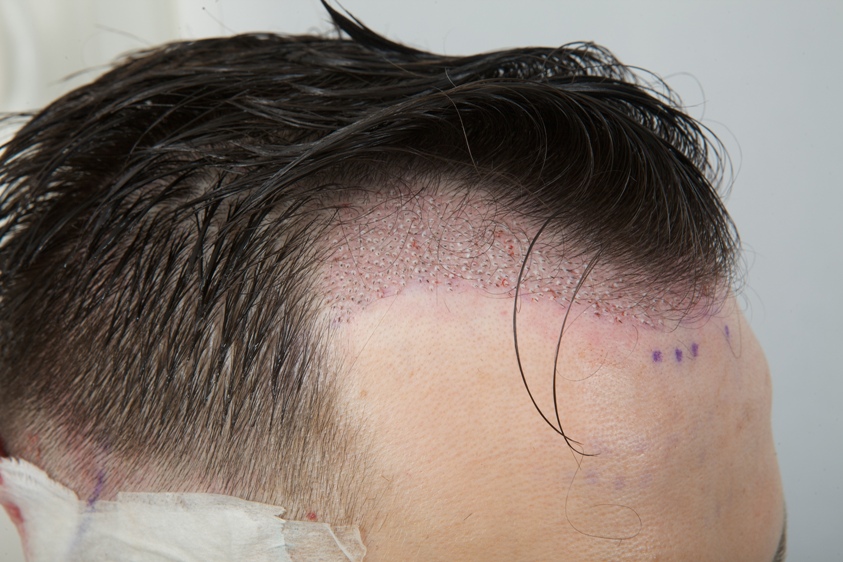 Hair Transplant Recipient