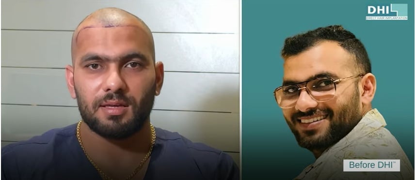 Mr. Sachin’s Hair Transplant Before and After