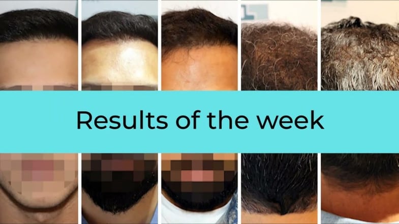 DHI Hair Transplant Results
