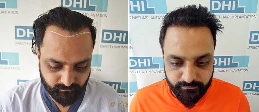 Hair Transplant Results Before and After