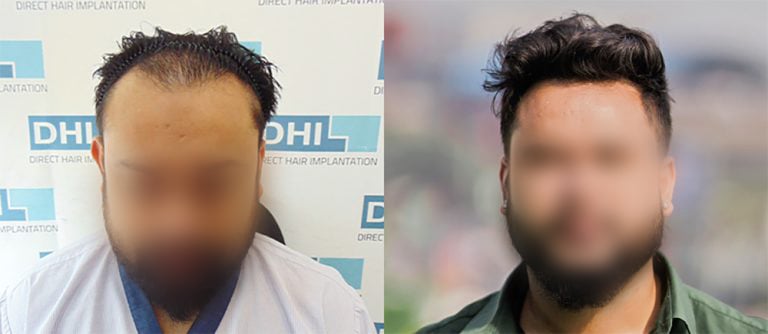 Hair Transplant Results