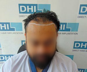 During the Hair Transplant Procedure