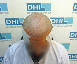 After DHI Hair Transplant Procedure