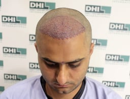 Rajat Hair Transplant 