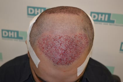 Hair Implantation at DHI India