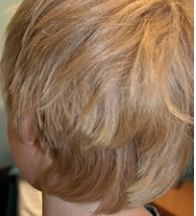 Loose-Anagen Syndrome