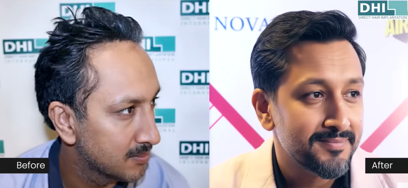Mr. Surinder Oberoi Hair Transplant at DHI